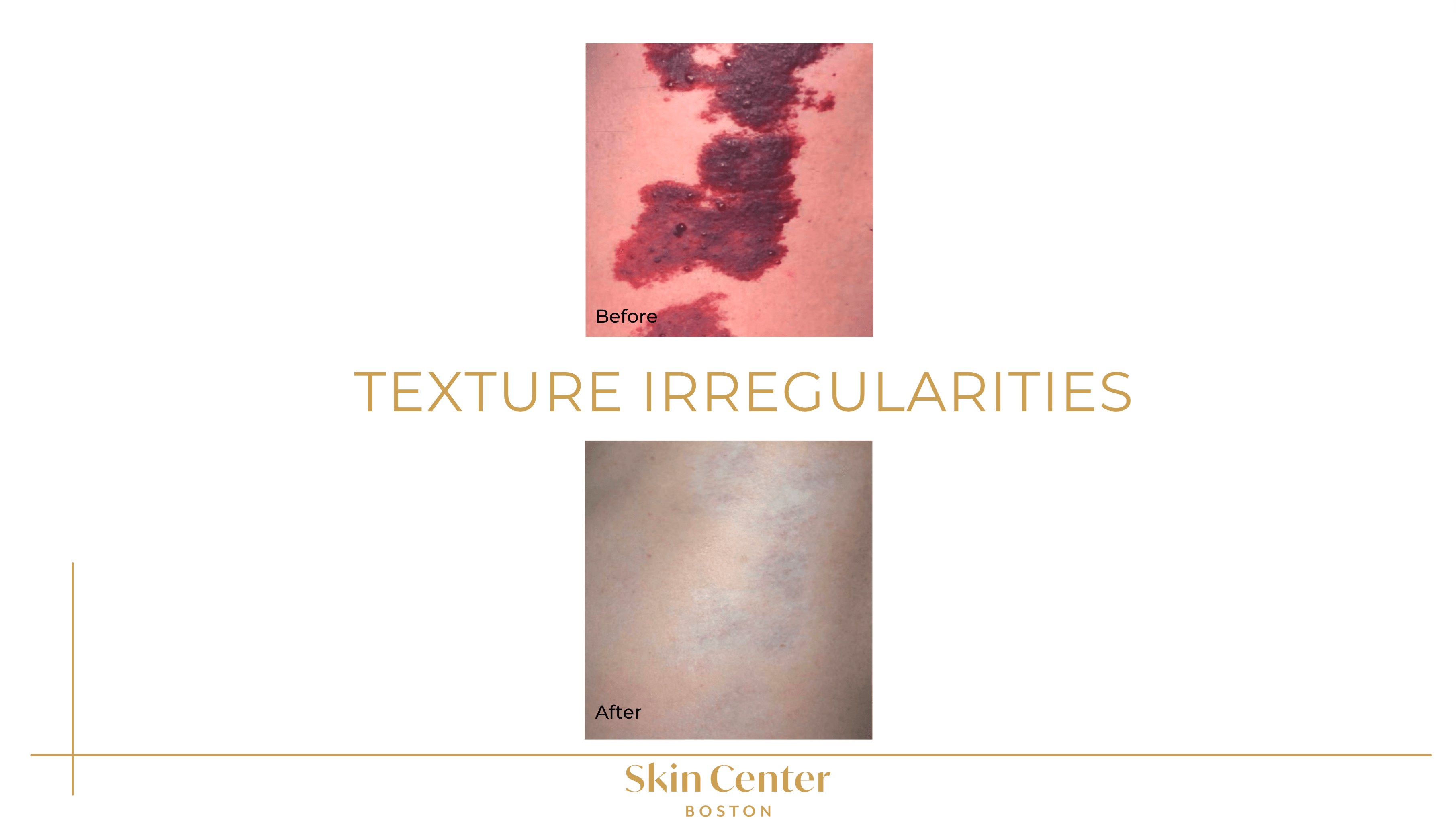 IPL - Texture Irregulartities